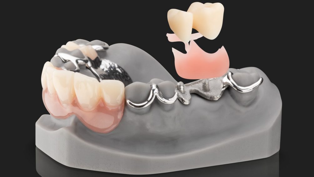 WIRONIUM RP Complete von BEGO WIRONIUM RP Complete von BEGO