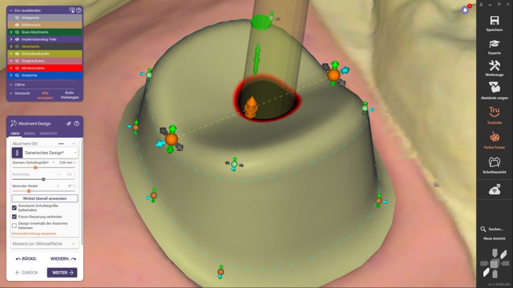 DentalCAD 3.3 Chemnitz Release: Fissuren-Video DentalCAD 3.3 Chemnitz Release: Fissuren-Video