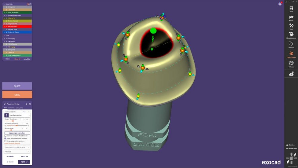Dental CAD Chemnitz: Neue Funktionen beim Abutment-Design