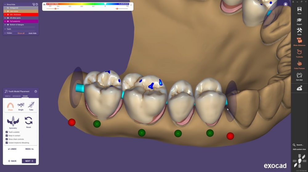 exocad DentalCAD: Instant Anatomic Morphing für mehrere Zähne