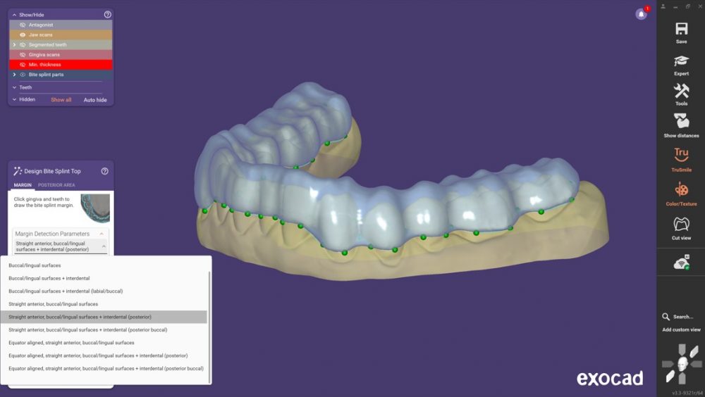 Verbesserte KI-gestützte Aufbissschienen-Designs mit exocad DentalCAD 3.3 Chemnitz