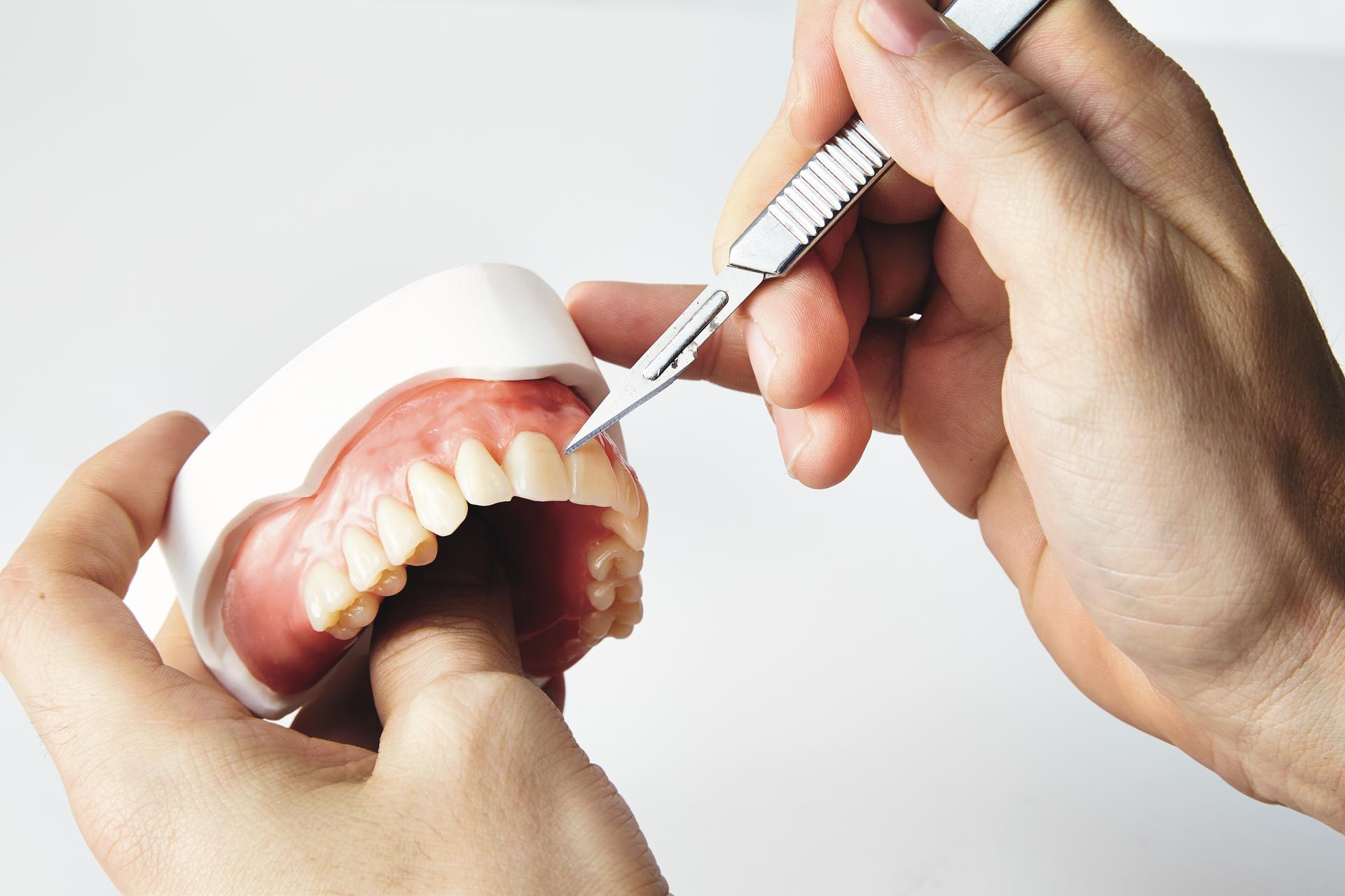 Setup - Lingualisierte Totalprothetik nach dem GERBER-Konzept