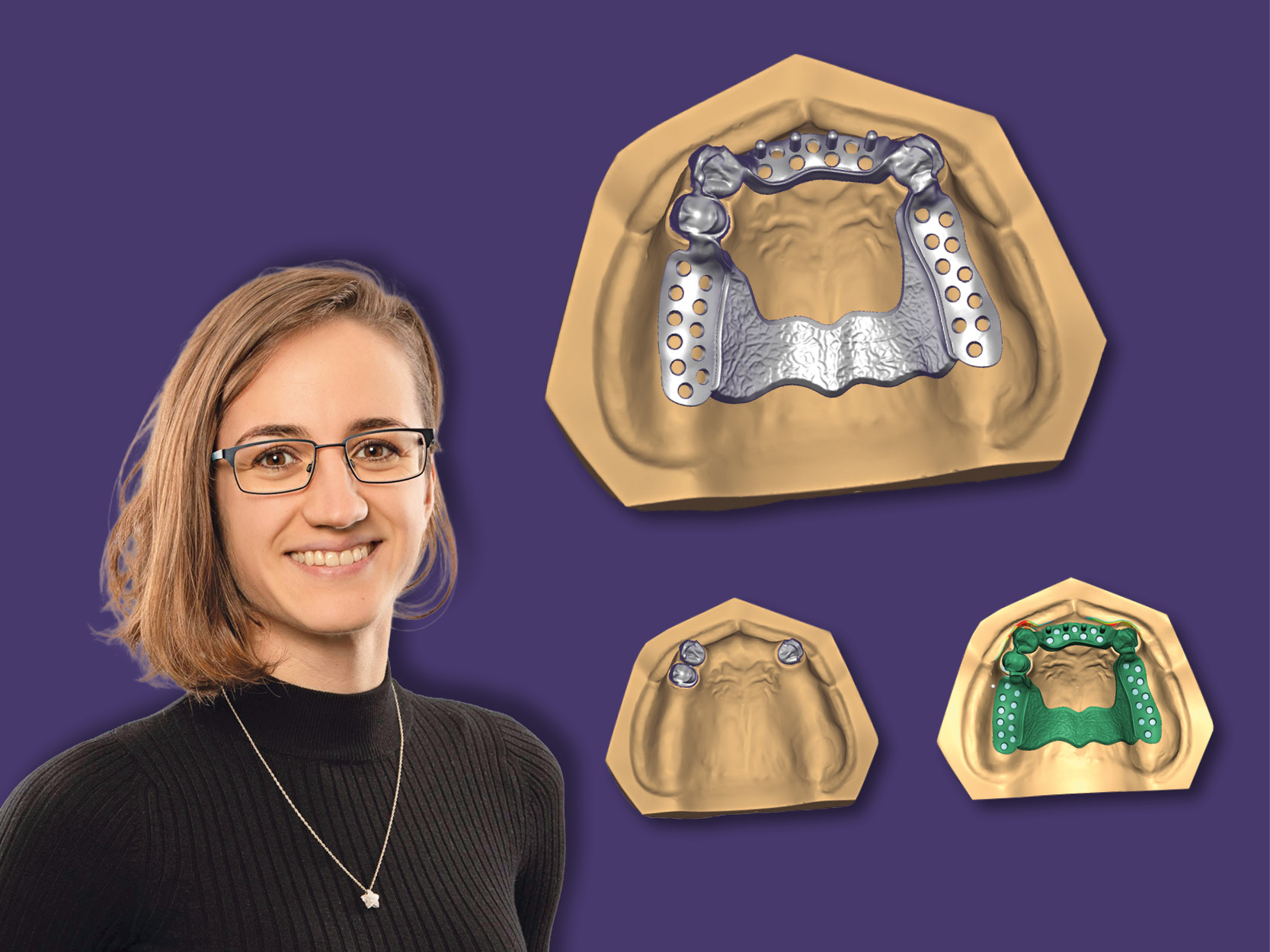 Modellguss + Sekundärteleskope – die perfekte Kombi in Exocad