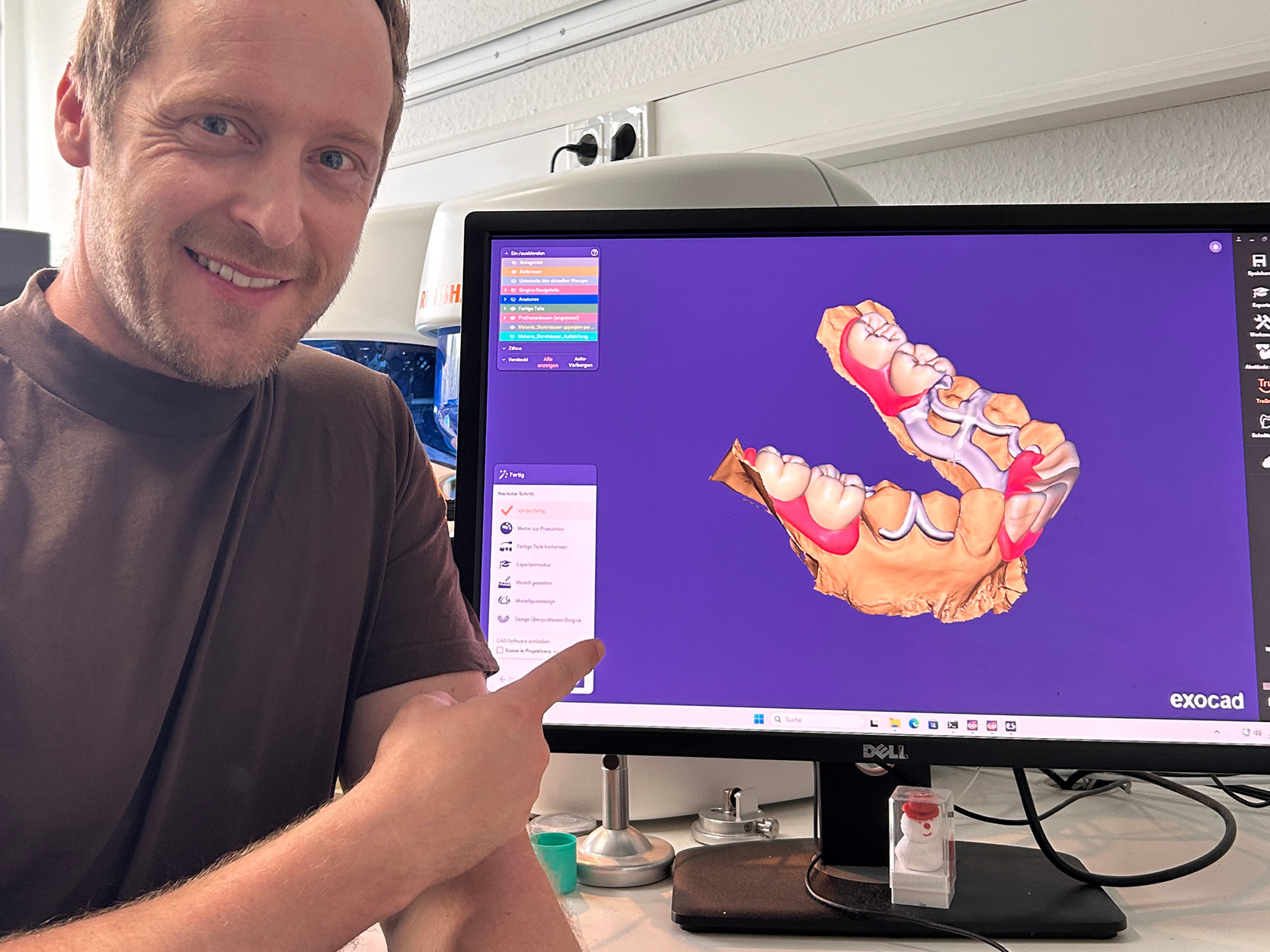 Modular Denture by CADdent® – die digitale Teilprothese in Exocad mit Niels